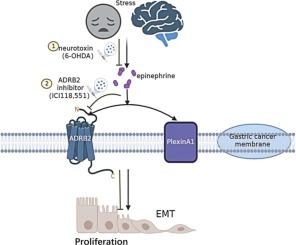 Chronic stress promotes gastric cancer progression via the adrenoceptor beta 2/PlexinA1 pathway