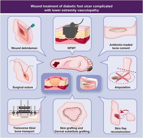 Diagnosis and treatment of diabetic foot ulcer complicated with lower extremity vasculopathy: Consensus recommendation from the Chinese Medical Association (CMA), Chinese Medical Doctor Association (CMDA)