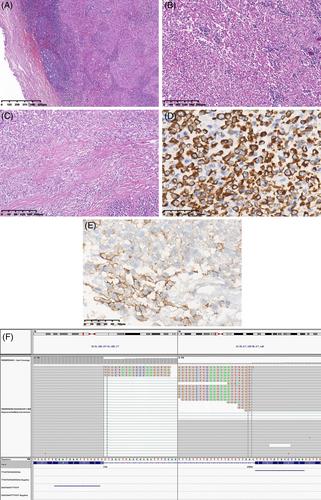 A 24-year-old woman with a recurrent intracranial mass