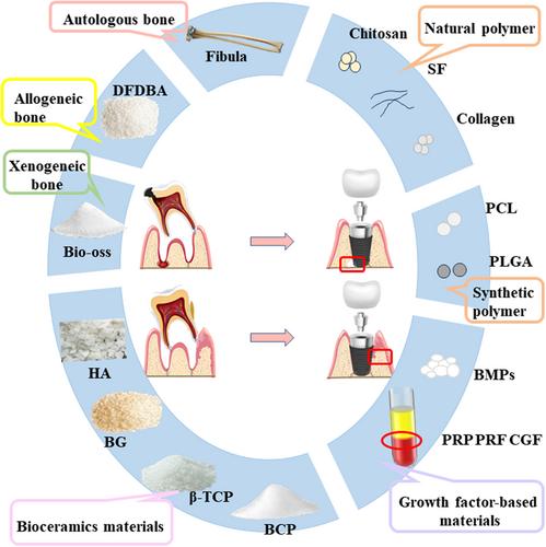 Multiple biomaterials for immediate implant placement tissue repair: Current status and future perspectives