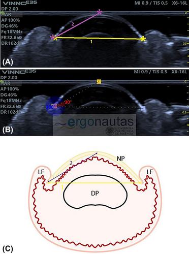 Ultrasound clinical references of the healthy toenail unit