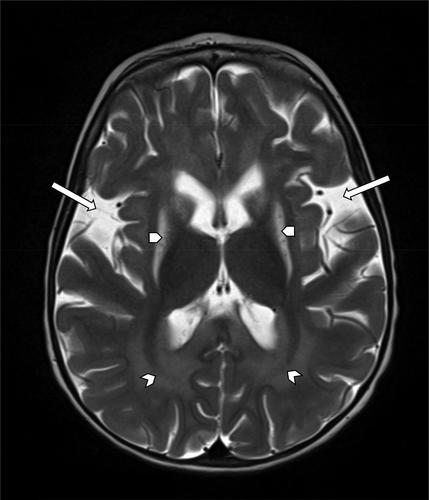 Fatal cervical myelopathy in a child with glutaric aciduria type 1