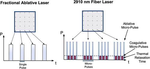 Full-face and neck resurfacing with a novel ablative fractional 2910 nm erbium-doped fluoride glass fiber laser for advanced photoaging