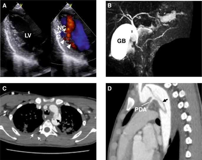 Cardiac manifestations of human ACTA2 variants recapitulated in a zebrafish model