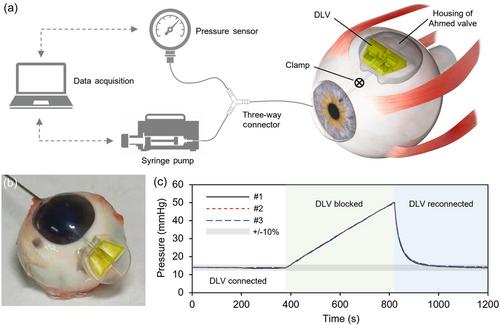 Droplet Laplace valve-enabled glaucoma implant for intraocular pressure management