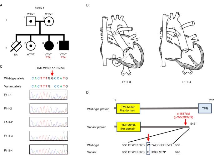 The c.1617del variant of TMEM260 is identified as the most frequent single gene determinant for Japanese patients with a specific type of congenital heart disease