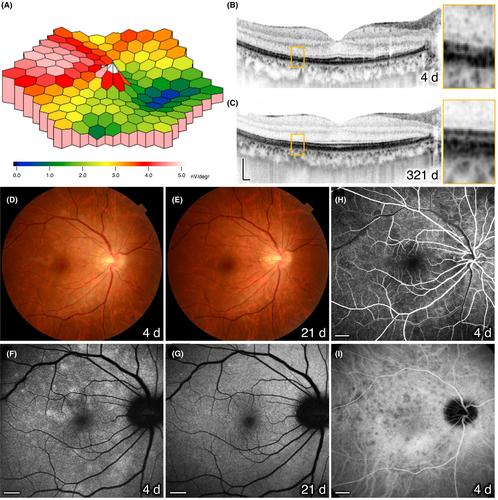 Comparison of clinical findings and subjective symptoms in a case of multiple evanescent white dot syndrome (MEWDS): A case report from a patient's perspective