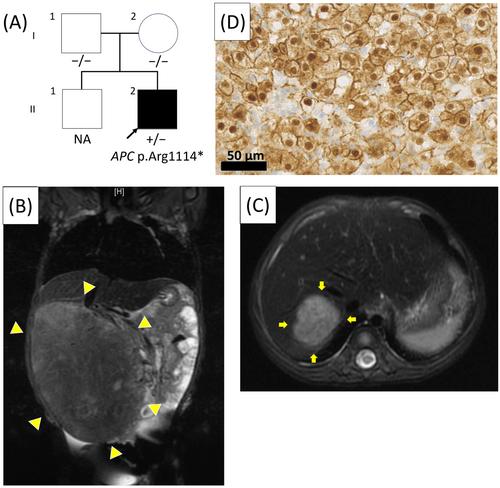 Multiple hepatoblastomas with positive β-catenin immunostaining as a potential indication for germline APC genetic testing: A case report