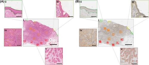 The combined immunohistochemical expression of AMBRA1 and SQSTM1 identifies patients with poorly differentiated cutaneous squamous cell carcinoma at risk of metastasis: A proof of concept study