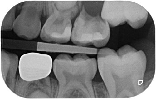 Survival of pre-formed zirconia crowns in primary teeth: a prospective practice-based cohort study