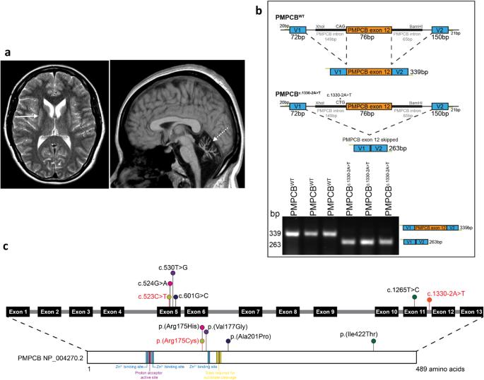 Leigh syndrome with developmental regression and ataxia due to a novel splicing variant in the PMPCB gene