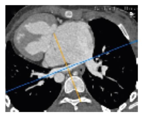 Pulmonary Venous Index as Additional Diagnostic Criteria for Fontan Palliation