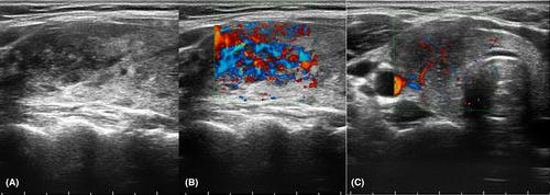 Diagnostic value of colour Doppler ultrasound in differentiating malignant and benign nodules in thyroiditis background