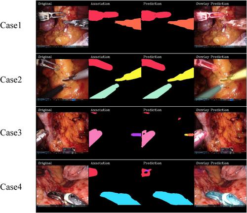 Evaluating surgical expertise with AI-based automated instrument recognition for robotic distal gastrectomy