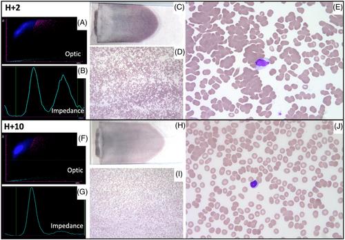 Transient red blood cell agglutination after Magrolimab administration in acute myeloid leukemia