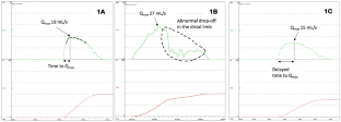 The Use of Uroflowmetry as a Diagnostic Test.