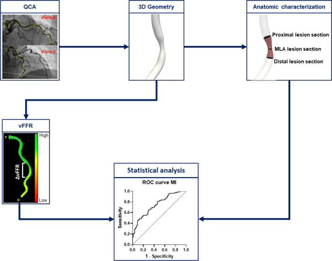 Association Between Automated 3D Measurement of Coronary Luminal Narrowing and Risk of Future Myocardial Infarction.