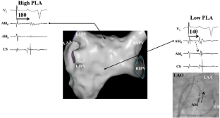 Posterior left atrial isolation is associated with a lower incidence of atrial tachycardia in patients with persistent atrial fibrillation.