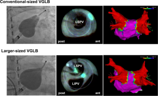 Quantitative comparison of the isolation lesions between conventional- and larger-sized visually guided laser balloon ablation.