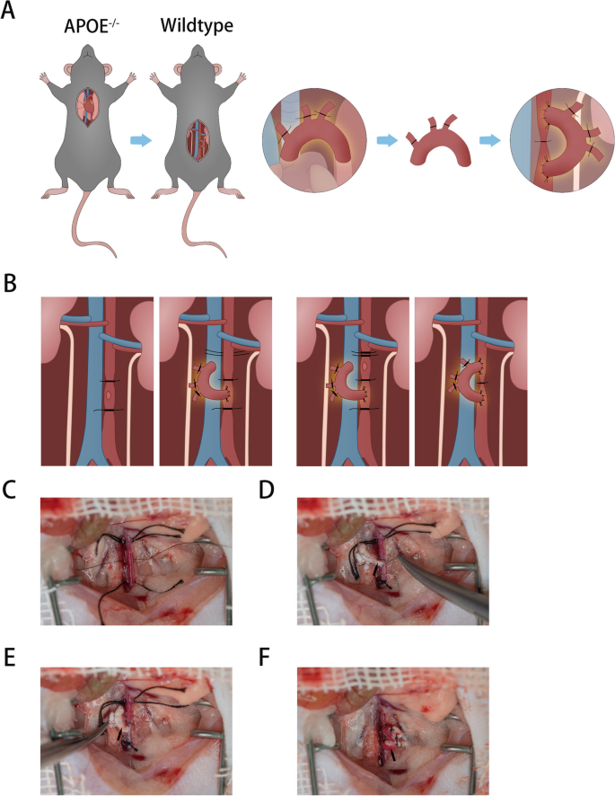 Allograft Model of Aortic Arch Segment Grafting to Abdominal Aorta Through End-to-Side Anastomosis in Mice.