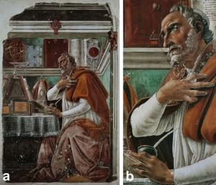 Saint Augustine in his studio by Sandro Botticelli (1445-1510): a representation of Hemochromatosis?