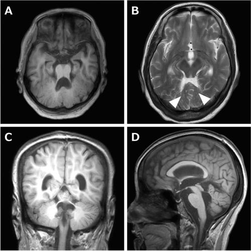 Case Report: An Adult Case of Poretti-Boltshauser Syndrome Diagnosed by Medical Checkup.