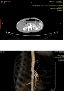 Co-existent Median Arcuate Ligament Syndrome and Superior Mesenteric Artery Syndrome