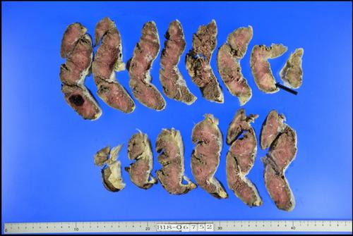 Genetic and histological analysis intraplacental choriocarcinoma: a case report.