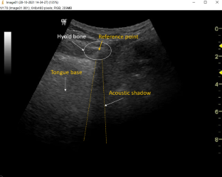 Hyoid Bone Movement During Swallowing in Female Thyroidectomy Patients: A Kinematic Ultrasound Study.