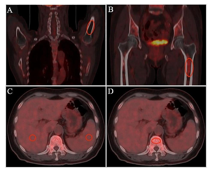 Assessment of diffuse bone marrow involvement on 18F-fluoro-D-glucose PET/computed tomography