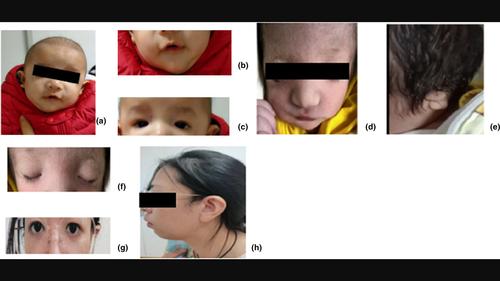 Two novel pathogenic variants in the TCOF1 found in two Chinese cases of Treacher Collins syndrome.