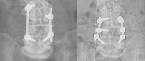 Phase field modelling and simulation of damage occurring in human vertebra after screws fixation procedure