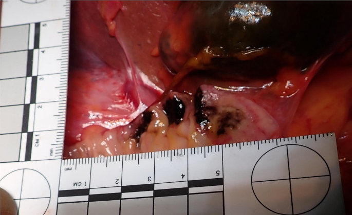 Acute necrotizing duodenitis in diabetic ketoacidosis.