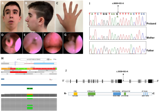 Combined exome and whole transcriptome sequencing identifies a de novo intronic SRCAP variant causing DEHMBA syndrome with severe sleep disorder