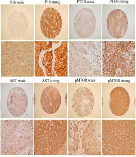 Clinical and molecular characteristics of Jordanian oropharyngeal cancer patients according to P16 expression: a retrospective study and a report of a novel biomarker.