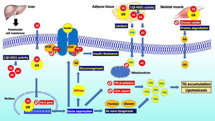 Role of Glucocorticoids in Metabolic Dysfunction-Associated Steatotic Liver Disease.