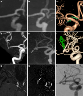 Diagnostic Performance of Pointwise Encoding Time Reduction with Radial Acquisition Subtraction-based MR Angiography in the Follow-up of Intracranial Aneurysms after Clipping.