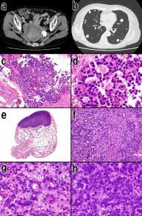 Alpha-fetoprotein producing endometrioid carcinoma arising in an adenomyoma of the uterus