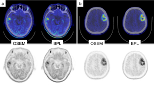 Impact of [11C]methionine PET with Bayesian penalized likelihood reconstruction on glioma grades based on new WHO 2021 classification