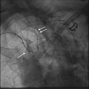 Cerebral Embolic Protection Devices for Transcatheter Aortic Valve Replacement: Review of the Literature and Future Perspectives.