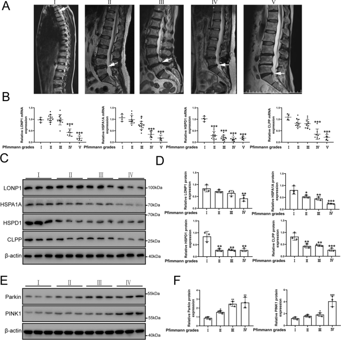 The mitochondrial UPR induced by ATF5 attenuates intervertebral disc degeneration via cooperating with mitophagy.