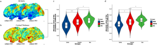 Altered functional-structural coupling may predict Parkinson's patient's depression.