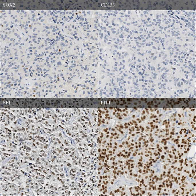 Pituitary tumours without distinct lineage differentiation express stem cell marker SOX2