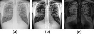 Classification of Lung Diseases Using an Attention-Based Modified DenseNet Model.