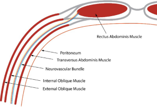 The role of indocyanine green fluorescence angiography in ventral hernia repair.