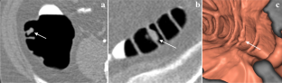 Paris classification of colonic polyps using CT colonography: prospective cohort study of interobserver variation.