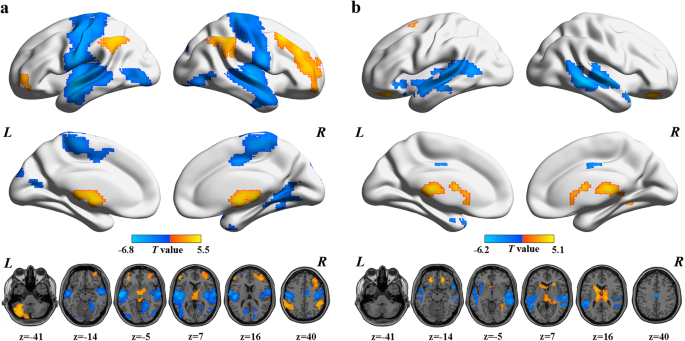 Exploring functional dysconnectivity in schizophrenia: alterations in eigenvector centrality mapping and insights into related genes from transcriptional profiles.