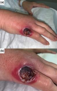 'Lesion on the back of the hand in a hematopoietic stem cell transplant recipient'.