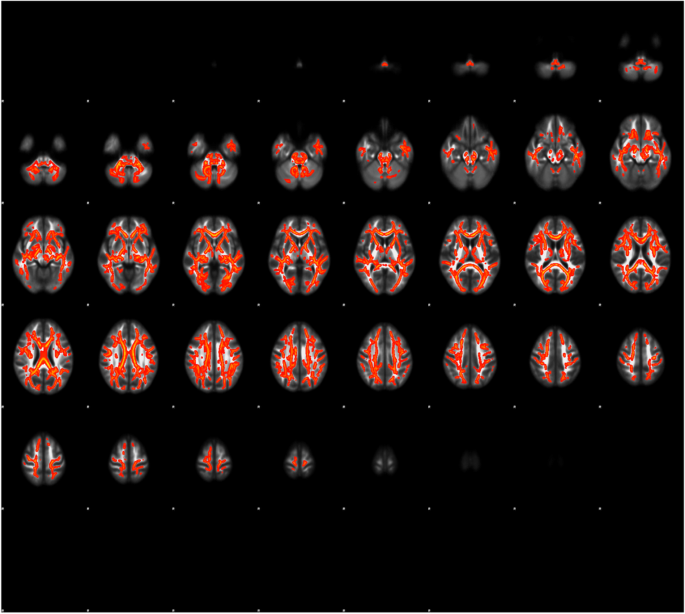 Association of homocysteine with white matter dysconnectivity in schizophrenia