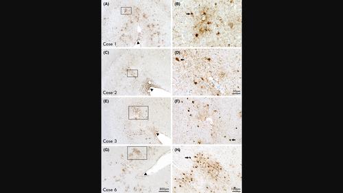 Chronic traumatic encephalopathy neuropathologic change in former Australian rugby players